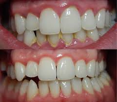Dental Bonding near me Dental Bonding near me