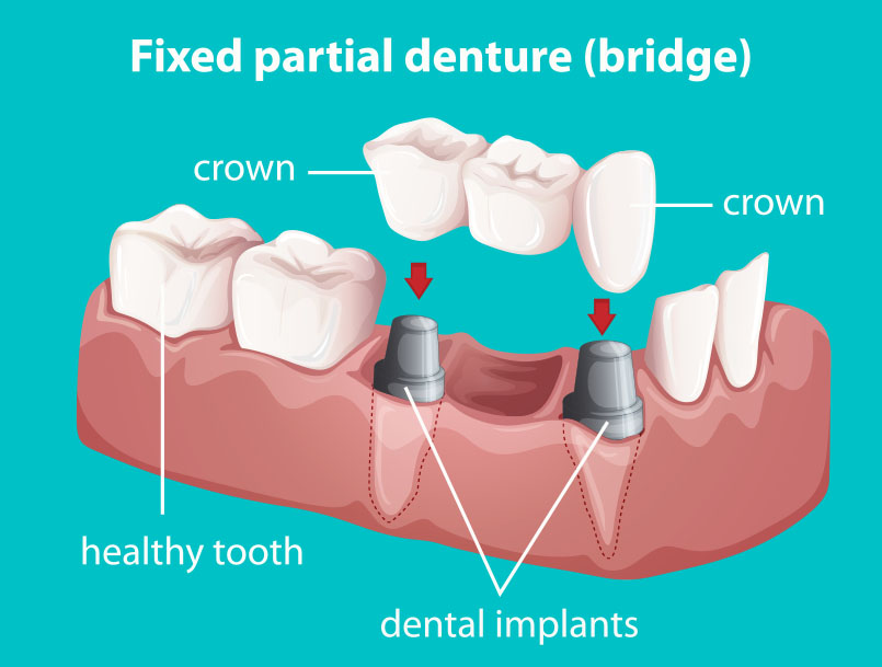 Dental Bridges Near Me Dental Bridges Near Me