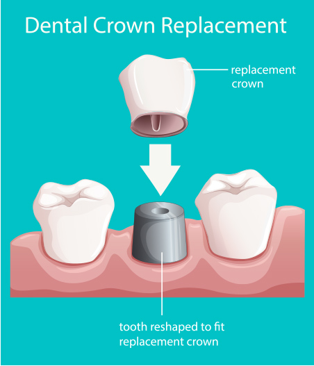 Dental Crowns Near Me Dental Crowns Near Me