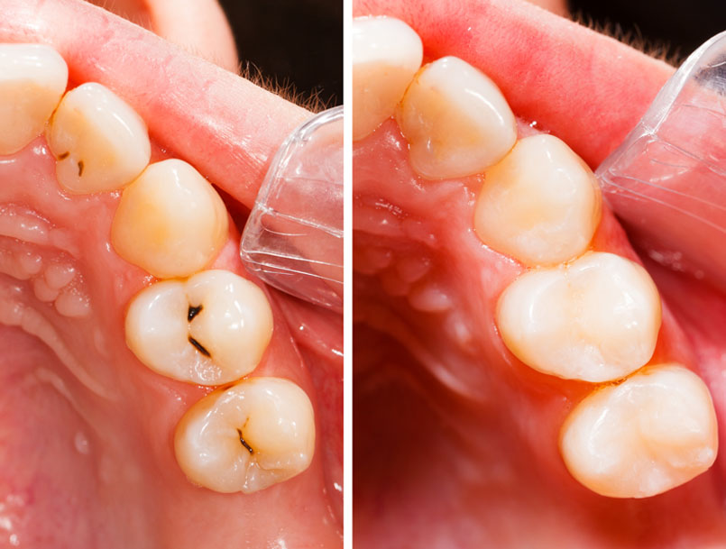 Dental Fillings Near Me Dental Fillings Near Me