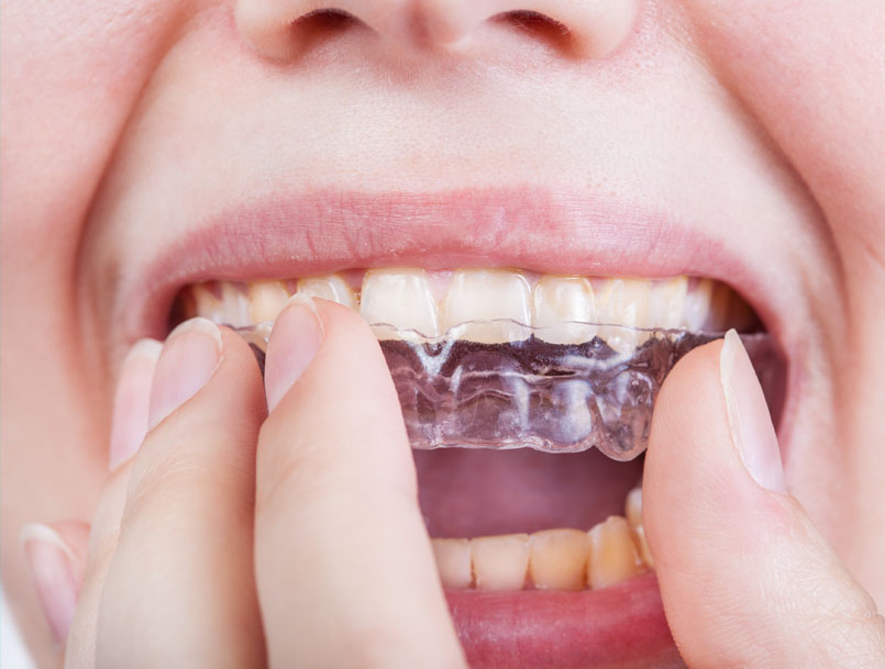 dental crown Mouthguards Near Me