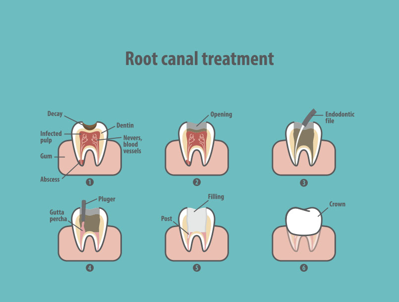 Root Canal Near Me Root Canal Near Me