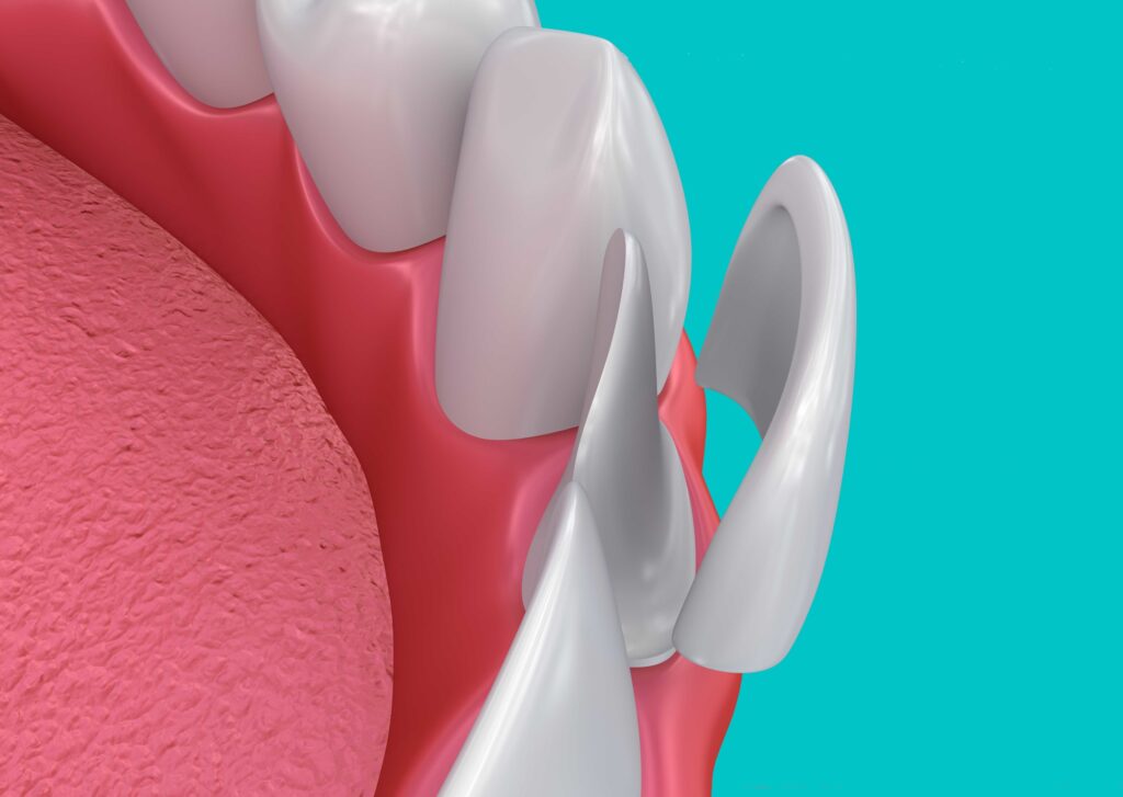 Dental Veneers Near Me Dental Veneers Near Me