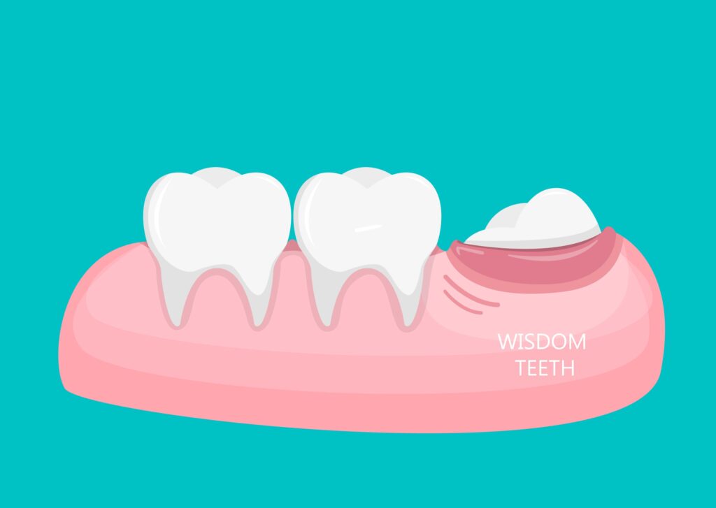 Wisdom Teeth Removal Near Me Wisdom Teeth Removal Near Me