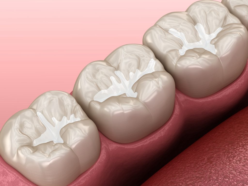 Dental Sealants