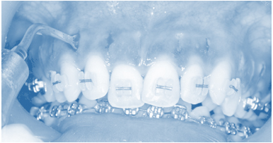 Accelerated Orthodontics