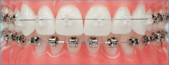 Adult Orthodontics